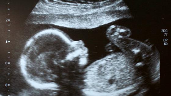 560x315 Study Prenatal Ultrasound Exposure Unlikely To Cause Autism
