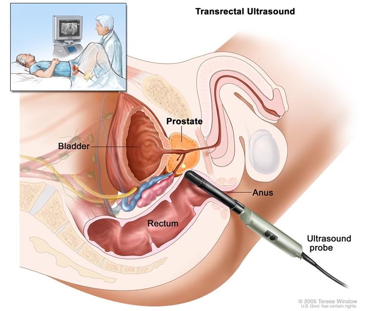 750x639 Transrectal Ultrasound Drawing Shows A Side View Of The Male