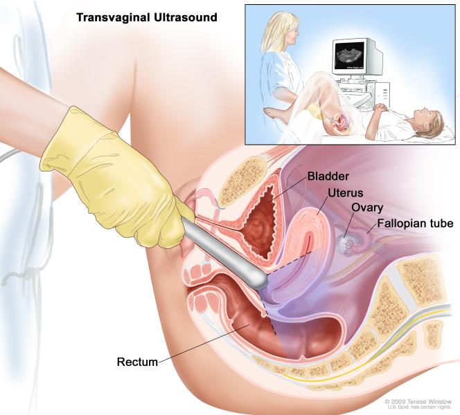 664x600 Transvaginal Ultrasound Drawing Shows A Side View Of The Female