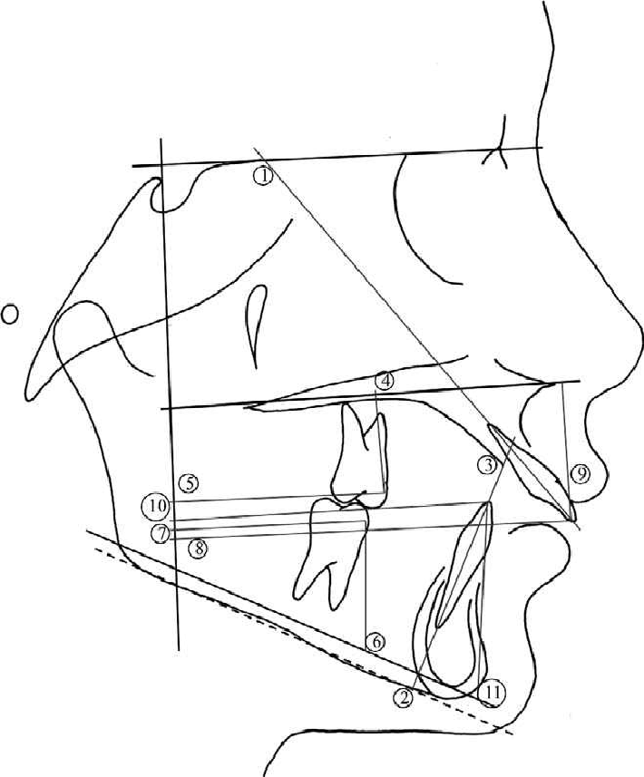 710x857 Dental Parameters. (A) Angular Measurements (U) 1, U1sn 2, Impa