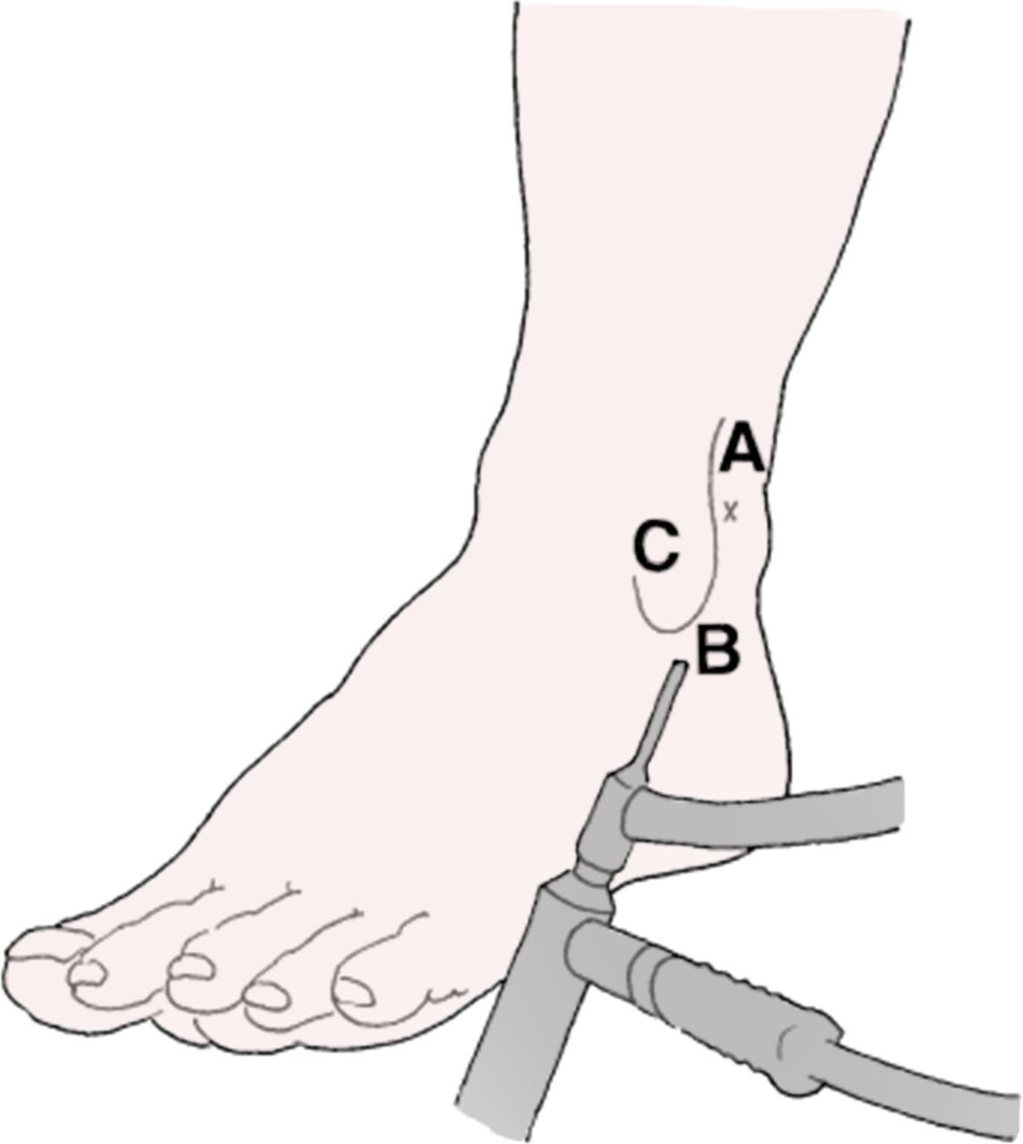 1145x1280 Ankle Tendoscopy State Of The Art Journal Of Isakos Joint