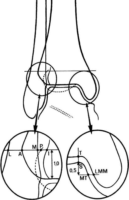 512x793 A Schematic Drawing Of The Ankle Shows Landmarks Used F Open I