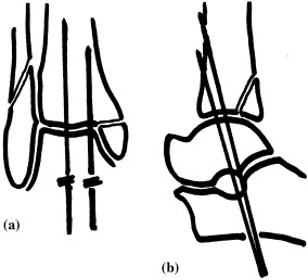 284x258 Schematic Drawing Of Retrograde Kirschner Wire Ankle Transfixation