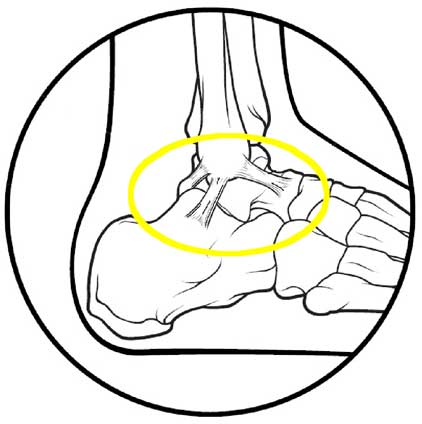 422x424 Ankle Sprains