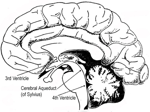 500x376 Aqueductal Stenosis