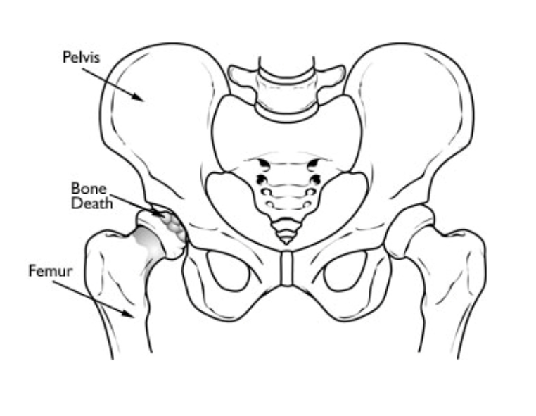 762x591 Osteonecrosis Of The Hip