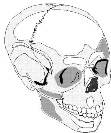 385x460 Pain In The Back Of My Head Behind Ear