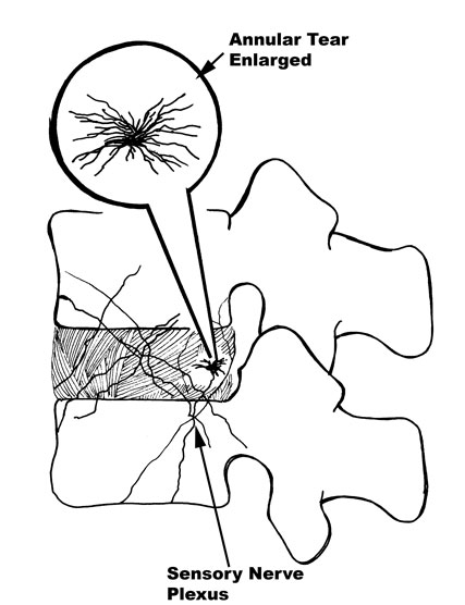 427x556 Causes Of Lower Back Pain Spine Specialist Vail, Aspen, Denver Co