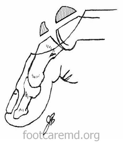 468x551 Hallux Rigidus