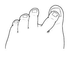 236x189 Muscle Or Tendon Imbalances In Your Foot Can Cause Youres