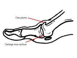 250x188 Big Toe Joint Pain