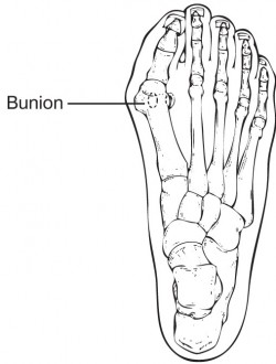250x330 Bunions