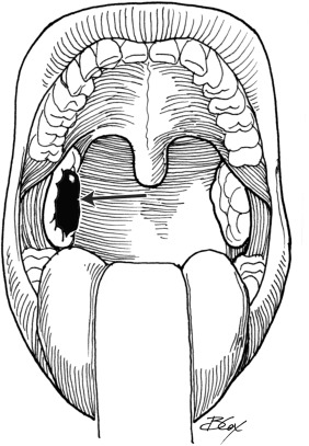 282x407 Operative Management Of Catastrophic Bleeding In The Head And Neck