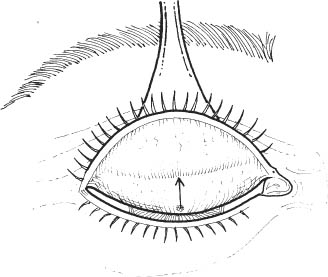 328x277 Ptosis Repair Ento Key