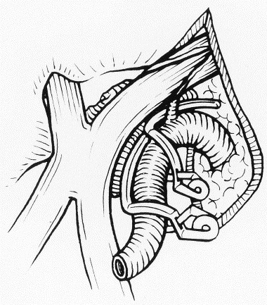 380x433 Clinoid And Paraclinoid Aneurysms Surgical Anatomy, Operative