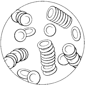 300x296 Rouleaus Definition Of Rouleaus By Medical Dictionary