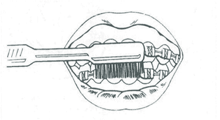 450x246 Braces Aftercare