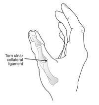 200x212 Broken Finger Cast Or Splint