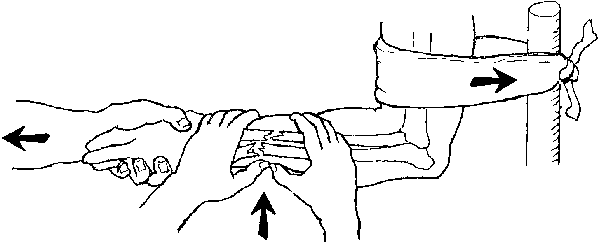 599x242 Broken Bones (Fractures)