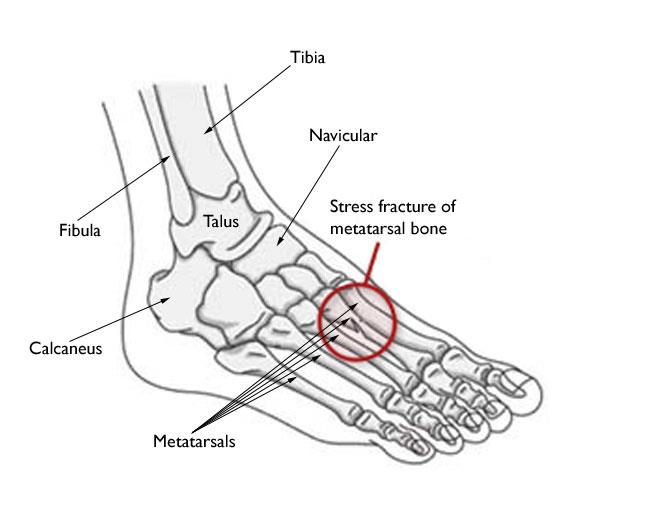 650x511 Stress Fractures Of The Foot And Ankle