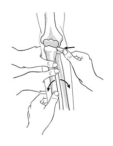233x300 Broken Leg Art