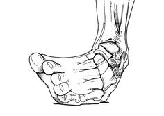 236x167 64 Best Broken Foot Images On Broken Leg, Ankle