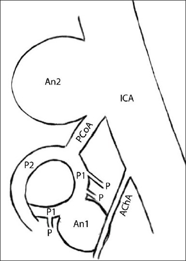 384x537 Schematic Drawing Of The Pcoa Complex, Showing The Angi Open I