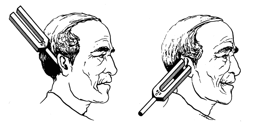 979x524 Rinne Test Medlibes Online Medical Library