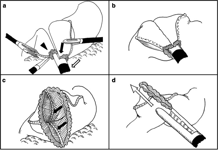 750x516 Schematic Outline Of The Delta Shaped Gastroduodenostomy. A Small