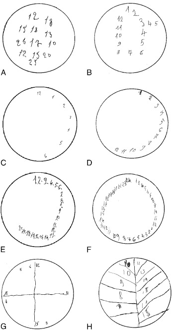 346x667 Chapter 19 Visuospatial And Visuoconstructive Deficits