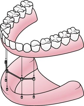 Denture Drawing at GetDrawings | Free download