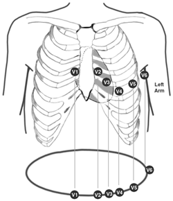 250x290 Ecg Lead Placement Earnurse