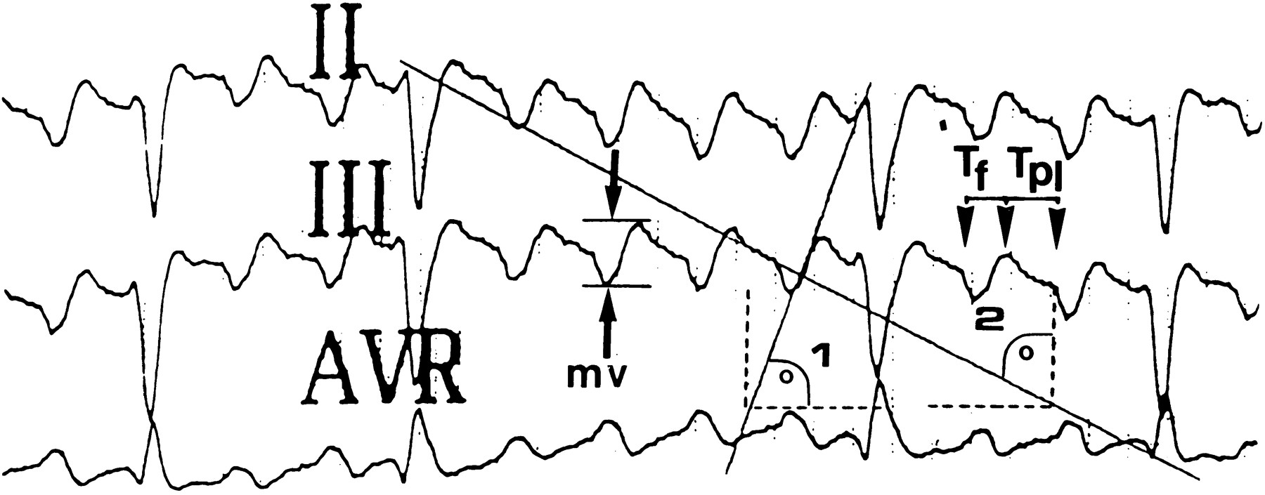 1800x705 Three Dimensional Mapping Of The Common Atrial Flutter Circuit