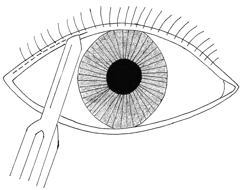 800x629 Community Eye Health Journal Performing A Tarsorrhaphy