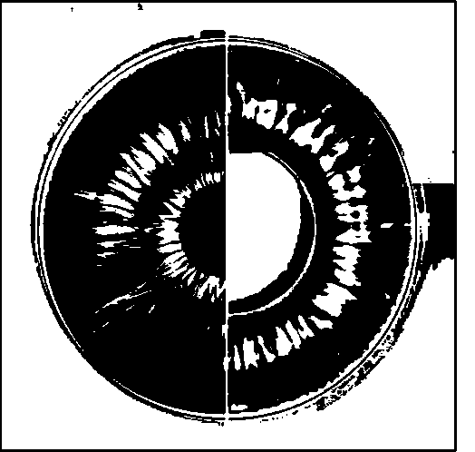 524x498 Surgical Methods To Expand The Pupil