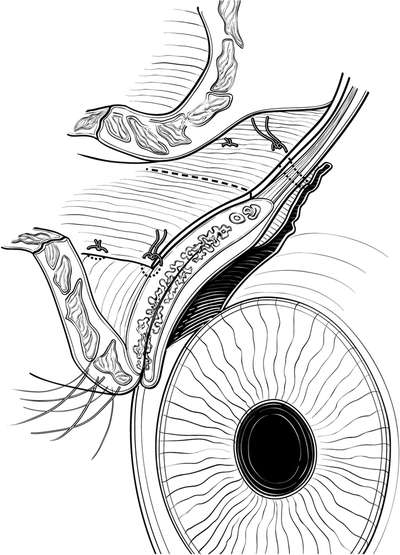 400x555 Complications Of Ptosis Repair Prevention And Management