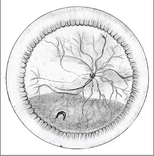 650x655 Retinal Physician
