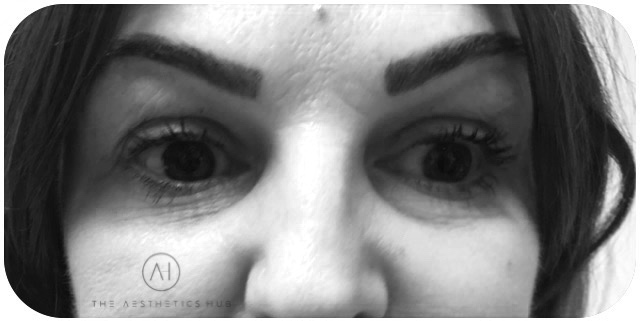 640x321 Under Eye Treatment The Aesthetics Hub Liverpool