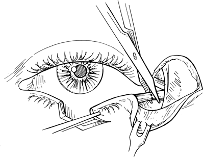 398x308 Eyelid Reconstruction Ento Key