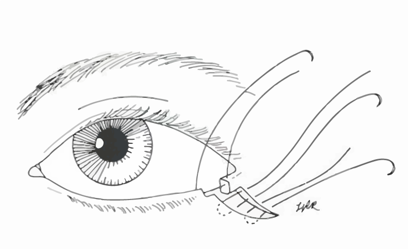 800x488 Eyelid Surgery