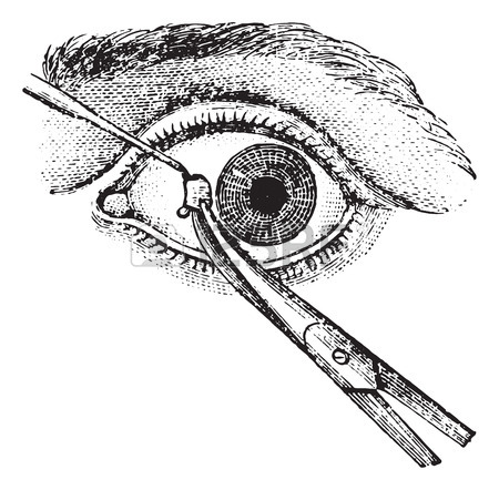 450x442 114 Eyelid Surgery Stock Vector Illustration And Royalty Free