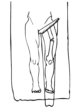 350x465 Overview Of Traction Techniques In Orthopaedic Surgery