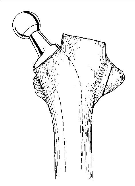 470x646 Vertical Osteotomy On A Femur In Which The Greater Trochanter Was