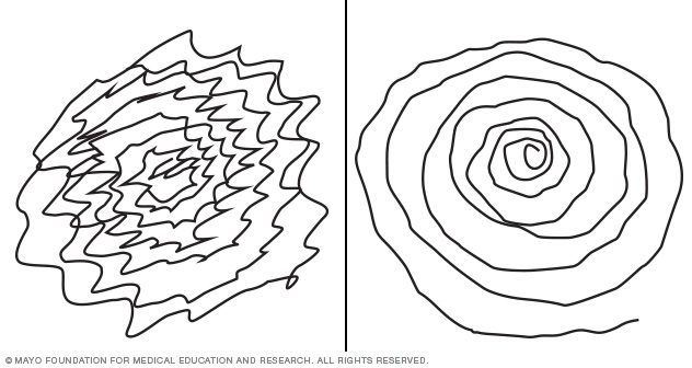 632x336 Essential Tremor