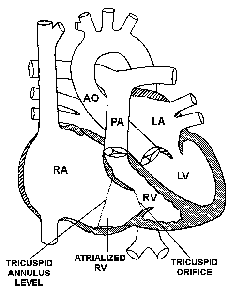 Heart Disease Drawing at GetDrawings | Free download