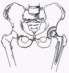 221x233 Hip Replacement