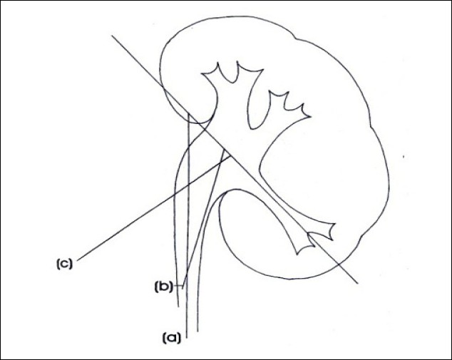 634x505 Saudi Journal Of Kidney Diseases And Transplantation (Sjkdt