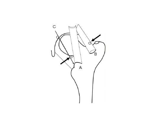 542x406 A. Line Drawing Of The Left Hip Anterior Ligaments. A)