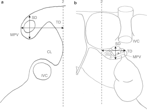 567x423 Schematic Drawing Of Liver, Showing Additional Landmarks