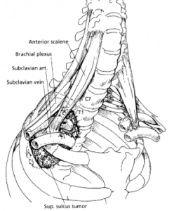 248x300 Pancoast Tumor